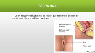 FISURA ANAL
– Es un desgarro longitudinal de la piel que recubre la porción del
canal anal distal a la línea pectínea.
 
