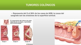 TUMORES COLÓNICOS
– Representa del 2 al 26% de los casos de HDB, la causa del
sangrado son las erosiones de la superficie luminal.
 