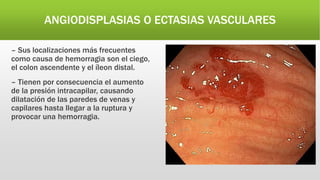 ANGIODISPLASIAS O ECTASIAS VASCULARES
– Sus localizaciones más frecuentes
como causa de hemorragia son el ciego,
el colon ascendente y el íleon distal.
– Tienen por consecuencia el aumento
de la presión intracapilar, causando
dilatación de las paredes de venas y
capilares hasta llegar a la ruptura y
provocar una hemorragia.
 