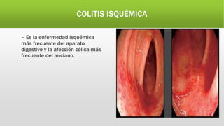COLITIS ISQUÉMICA
– Es la enfermedad isquémica
más frecuente del aparato
digestivo y la afección cólica más
frecuente del anciano.
 