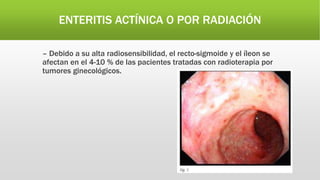 ENTERITIS ACTÍNICA O POR RADIACIÓN
– Debido a su alta radiosensibilidad, el recto-sigmoide y el íleon se
afectan en el 4-10 % de las pacientes tratadas con radioterapia por
tumores ginecológicos.
 