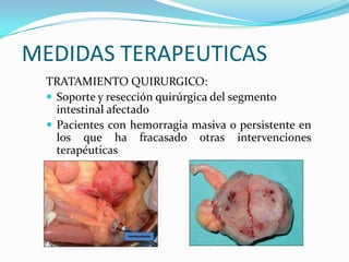 MEDIDAS TERAPEUTICAS
 TRATAMIENTO QUIRURGICO:
  Soporte y resección quirúrgica del segmento
   intestinal afectado
  Pacientes con hemorragia masiva o persistente en
   los que ha fracasado otras intervenciones
   terapéuticas
 