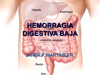 HEMORRAGIA
DIGESTIVA BAJA


JANER F. MARTINEZ R.
 