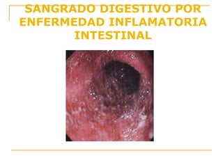 SANGRADO DIGESTIVO POR
ENFERMEDAD INFLAMATORIA
INTESTINAL
 
