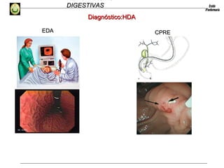 HEMORRAGIAS
DIGESTIVASDIGESTIVAS
Diagnóstico:HDADiagnóstico:HDA
EDAEDA CPRECPRE
 