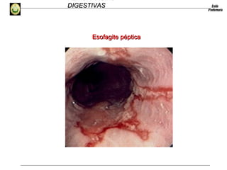 HEMORRAGIAS
DIGESTIVASDIGESTIVAS
Esofagite pépticaEsofagite péptica
 