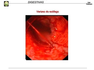 HEMORRAGIAS
DIGESTIVASDIGESTIVAS
Varizes do esôfagoVarizes do esôfago
 