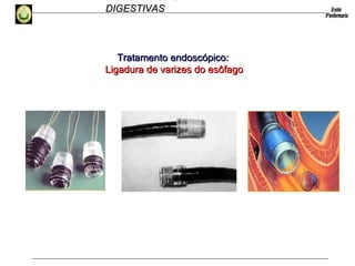 HEMORRAGIAS
DIGESTIVASDIGESTIVAS
Tratamento endoscópico:Tratamento endoscópico:
Ligadura de varizes do esôfagoLigadura de varizes do esôfago
 