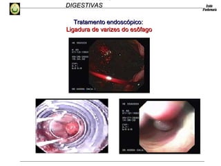 HEMORRAGIAS
DIGESTIVASDIGESTIVAS
Tratamento endoscópico:Tratamento endoscópico:
Ligadura de varizes do esôfagoLigadura de varizes do esôfago
 