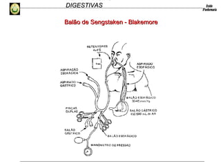 HEMORRAGIAS
DIGESTIVASDIGESTIVAS
Balão de Sengstaken - BlakemoreBalão de Sengstaken - Blakemore
 
