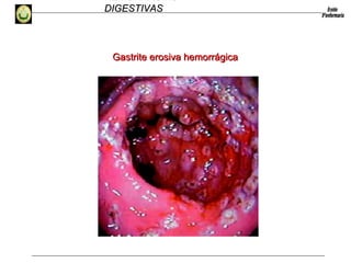 HEMORRAGIAS
DIGESTIVASDIGESTIVAS
Gastrite erosiva hemorrágicaGastrite erosiva hemorrágica
 