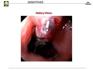 HEMORRAGIAS
DIGESTIVASDIGESTIVAS
Mallory-WeissMallory-Weiss
 
