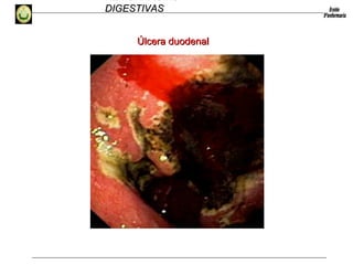 HEMORRAGIAS
DIGESTIVASDIGESTIVAS
Úlcera duodenalÚlcera duodenal
 