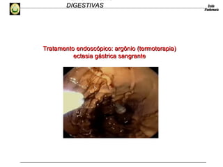 HEMORRAGIAS
DIGESTIVASDIGESTIVAS
Tratamento endoscópico: argônio (termoterapia)Tratamento endoscópico: argônio (termoterapia)
ectasia gástrica sangranteectasia gástrica sangrante
 