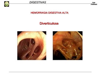 HEMORRAGIAS
DIGESTIVASDIGESTIVAS
DiverticuloseDiverticulose
HEMORRAGIA DIGESTIVA ALTAHEMORRAGIA DIGESTIVA ALTA
 