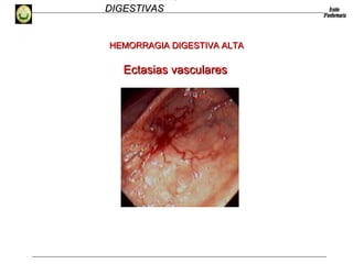 HEMORRAGIAS
DIGESTIVASDIGESTIVAS
Ectasias vascularesEctasias vasculares
HEMORRAGIA DIGESTIVA ALTAHEMORRAGIA DIGESTIVA ALTA
 