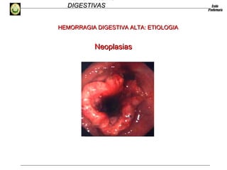 HEMORRAGIAS
DIGESTIVASDIGESTIVAS
NeoplasiasNeoplasias
HEMORRAGIA DIGESTIVA ALTA: ETIOLOGIAHEMORRAGIA DIGESTIVA ALTA: ETIOLOGIA
 