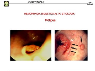 HEMORRAGIAS
DIGESTIVASDIGESTIVAS
PóliposPólipos
HEMORRAGIA DIGESTIVA ALTA: ETIOLOGIAHEMORRAGIA DIGESTIVA ALTA: ETIOLOGIA
 