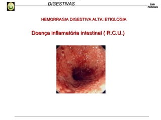 HEMORRAGIAS
DIGESTIVASDIGESTIVAS
Doença inflamatória intestinal ( R.C.U.)Doença inflamatória intestinal ( R.C.U.)
HEMORRAGIA DIGESTIVA ALTA: ETIOLOGIAHEMORRAGIA DIGESTIVA ALTA: ETIOLOGIA
 