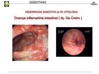 HEMORRAGIAS
DIGESTIVASDIGESTIVAS
Doença inflamatória intestinal ( dç. De Crohn )Doença inflamatória intestinal ( dç. De Crohn )
HEMORRAGIA DIGESTIVA ALTA: ETIOLOGIAHEMORRAGIA DIGESTIVA ALTA: ETIOLOGIA
 
