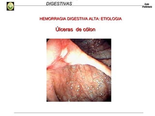 HEMORRAGIAS
DIGESTIVASDIGESTIVAS
Úlceras de cólonÚlceras de cólon
HEMORRAGIA DIGESTIVA ALTA: ETIOLOGIAHEMORRAGIA DIGESTIVA ALTA: ETIOLOGIA
 