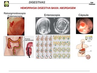 HEMORRAGIAS
DIGESTIVASDIGESTIVAS
HEMORRAGIA DIGESTIVA BAIXA: ABORDAGEMHEMORRAGIA DIGESTIVA BAIXA: ABORDAGEM
Enteroscopia Cápsula
Retosigmoidoscopia
Colonoscopia
 