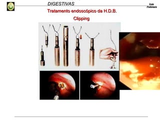HEMORRAGIAS
DIGESTIVASDIGESTIVAS
ClippingClipping
Tratamento endoscópico da H.D.B.Tratamento endoscópico da H.D.B.
 