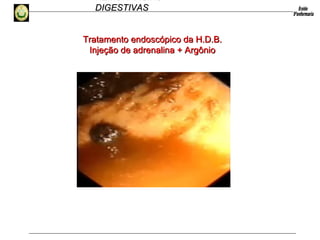 HEMORRAGIAS
DIGESTIVASDIGESTIVAS
Tratamento endoscópico da H.D.B.Tratamento endoscópico da H.D.B.
Injeção de adrenalina + ArgônioInjeção de adrenalina + Argônio
 