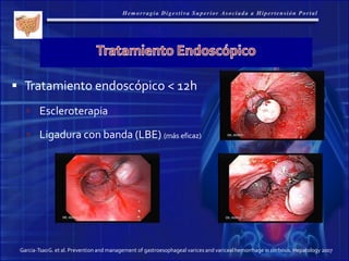 Garcia-TsaoG. et al. Prevention and management of gastroesophageal varices and varicealhemorrhage in cirrhosis. Hepatology 2007
 Tratamiento endoscópico < 12h
 Escleroterapia
 Ligadura con banda (LBE) (más eficaz)
 