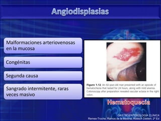 Malformaciones arteriovenosas
en la mucosa
Congénitas
Segunda causa
Sangrado intermitente, raras
veces masivo
GASTROENTEROLOGÍA CLÍNICA
Remes-Troche, Ramos de la Medina, Roesch Dietlen; 2ª Ed
 