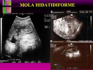 MOLA HIDATIDIFORME 