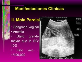 Manifestaciones Clínicas II. Mola Parcial Sangrado vaginal  Anemia Útero grande mayor que la EG: 10% Feto vivo : 1/100,000 