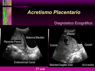 Acretismo Placentario Diagnóstico Ecográfico: 27 sem 
