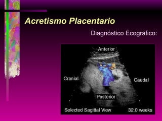 Acretismo Placentario Diagnóstico Ecográfico: 