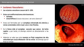 Hemorragia GastrointestinalSuperior No Variceal
Endoscopy 2015; 47(10): a1-a46
 Lesiones Vasculares:
 Las ectasias vasculares causan del 5- 10%
 Estas son malformaciones arteriovenosas:
 Asiladas
 Lineal Difusa (Ectasias Vasculares del antro Gástrico)*
 Estas son formadas por un complejo entramado de arterias y
venas conectadas entre sí por una o mas fistulas.
 Se le llama nido al complejo vascular que carece de lecho
capilar y por tanto, el drenaje arterial va directamente a las
venas.
 Además se sabe que este maneja un flujo sanguíneo de alta
velocidad que causa dilatación de las venas de drenaje que al
final se rompe
 