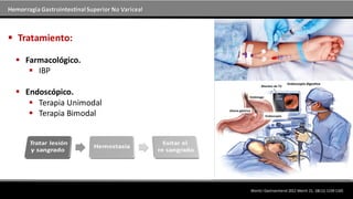 Hemorragia GastrointestinalSuperior No Variceal
 Farmacológico.
 IBP
 Endoscópico.
 Terapia Unimodal
 Terapia Bimodal
 Tratamiento:
WorldJ Gastroenterol 2012 March 21; 18(11):1159-1165
 