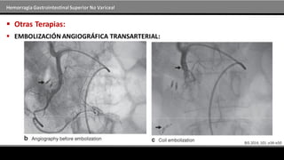 Hemorragia GastrointestinalSuperior No Variceal
 Otras Terapias:
 EMBOLIZACIÓN ANGIOGRÁFICA TRANSARTERIAL:
 