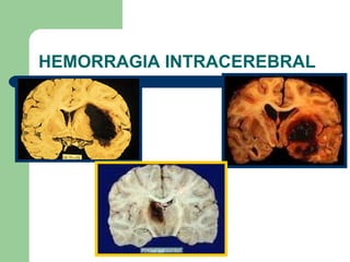 HEMORRAGIA INTRACEREBRAL 