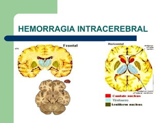 HEMORRAGIA INTRACEREBRAL 