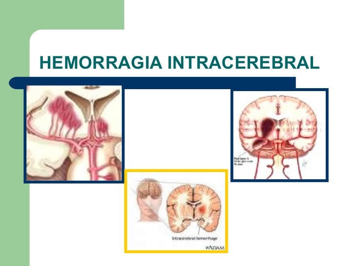 Hemorragia intracerebral