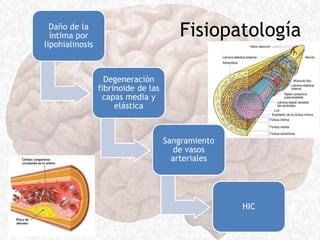 FisiopatologíaDaño de la
íntima por
lipohialinosis
Degeneración
fibrinoide de las
capas media y
elástica
Sangramiento
de vasos
arteriales
HIC
 