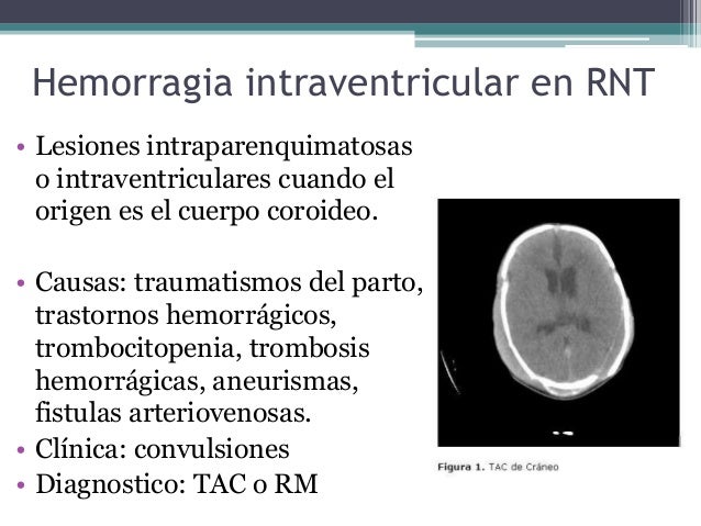 Hemorragia Intraventricular