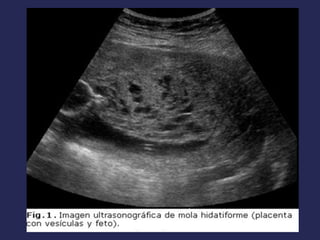 Hemorragia obstetrica