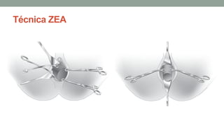 Técnica ZEA
 