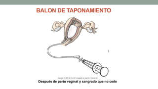 BALON DE TAPONAMIENTO
Después de parto vaginal y sangrado que no cede
 