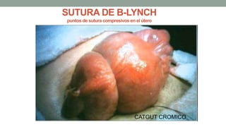 SUTURA DE B-LYNCH
puntos de sutura compresivos en el útero
CATGUT CROMICO
 