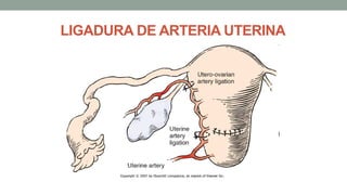 LIGADURA DE ARTERIA UTERINA
 
