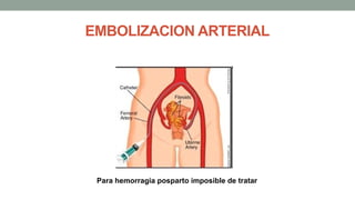 EMBOLIZACION ARTERIAL
Para hemorragia posparto imposible de tratar
 
