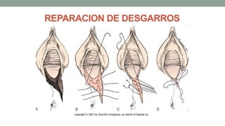 REPARACION DE DESGARROS
 