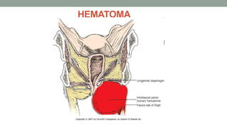 HEMATOMA
 